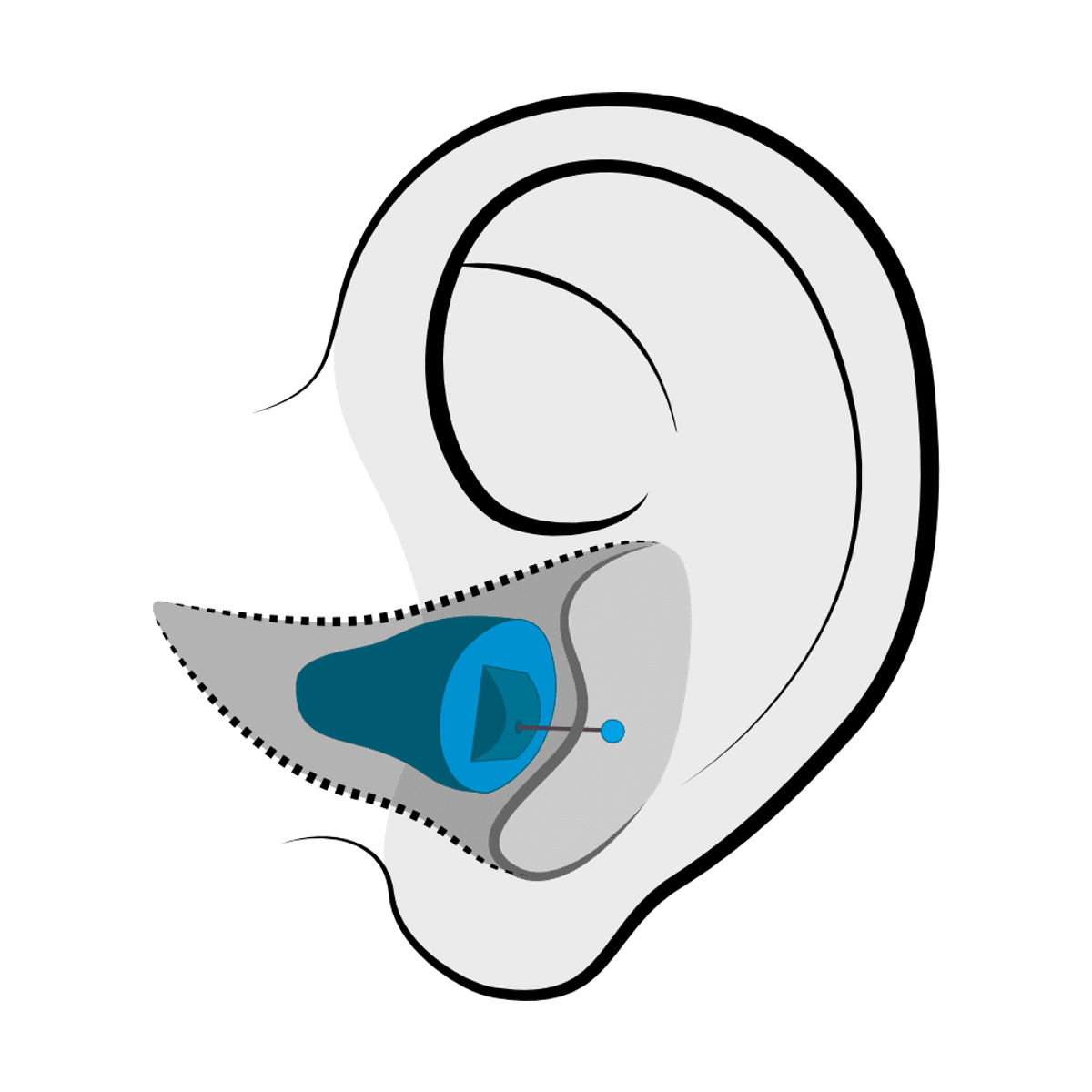 Invisible-in-Canal (IIC) hearing aid style fit at Contra Costa Hearing Aid Center in Brentwood, CA